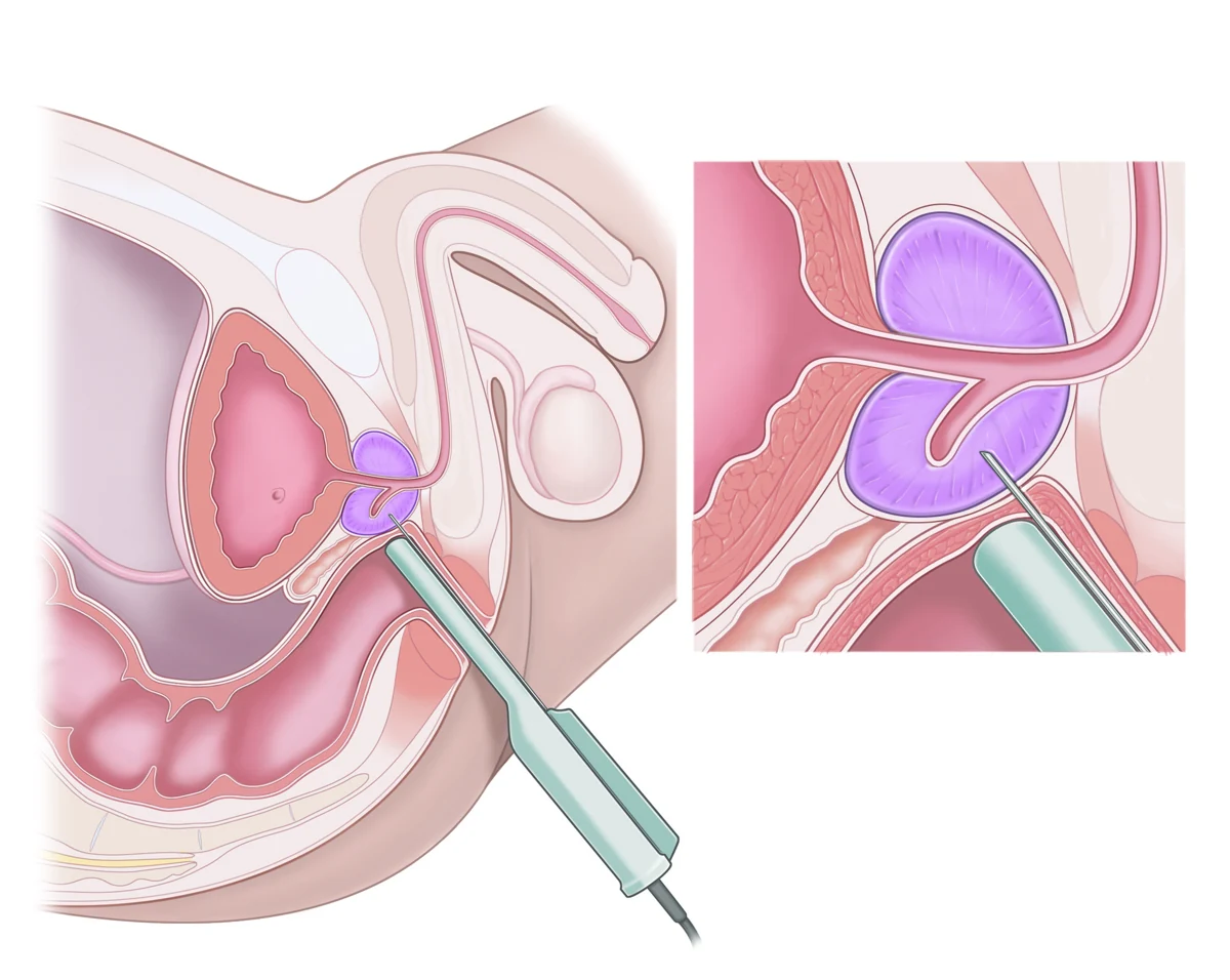 Prostat biyopsisinde ultrason probunu ve prostat dokusundan örnek alınmasını gösteren anatomik çizim
